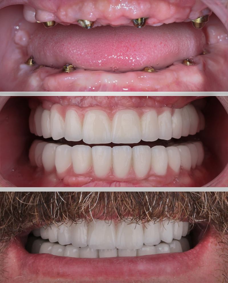 Tres imágenes: los pilares de los implantes en la encía, la prótesis fija ya colocada y la sonrisa del paciente.