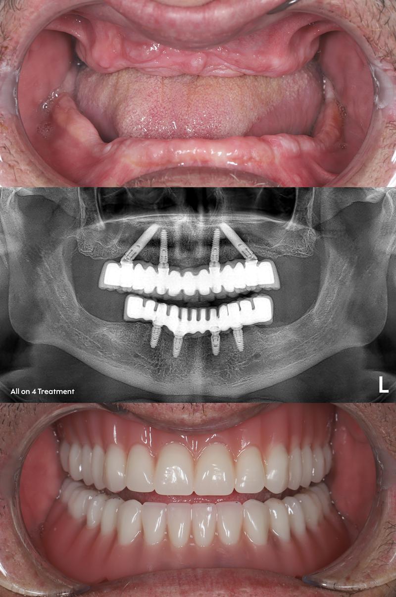 Tres imágenes: la boca sin dientes, la radiografía panorámica con cuatro implantes en cada maxilar y la sonrisa con las dos arcadas fijas.